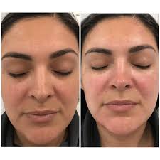 Skin Laser Hair Removal