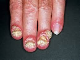 Image result for paronychium