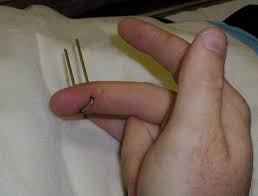 nail gun injuries litfl