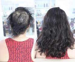Alopecia: entenda como o mega hair pode ajudar esse problema que afeta celebridades como Maraísa e Viviane Araújo
