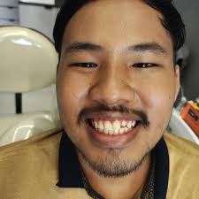 A healthy smile is just a visit away! Make sure to reserve your appointment  for routine dental check-up and scaling every 6 months to avoid unwanted  oral problems. #DentalCare #OralHealth #PreventionIsTheKey #RoutineCheckup