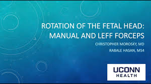 Image result for Manual Rotation in Occipitoposterior Presentation