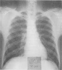 Image result for Pulmonary Intoxicant