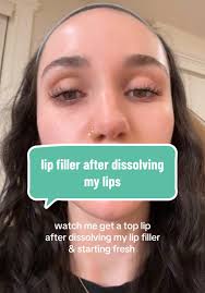 Lip Filler Transformation Journey: Starting Fresh