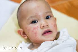 Image result for sweat rash on back baby