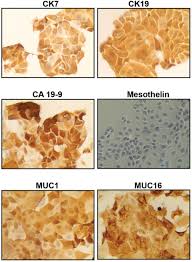 Marcela married claro gelago on month day 1934, at age 34 at marriage place. Functional And Genomic Characterization Of Three Novel Cell Lines Derived From A Metastatic Gallbladder Cancer Tumor