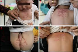 Image result for Varicella zoster on human skin