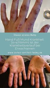 Hand Mund Fuss Bei Erwachsenen Ansteckend Und Schmerzhaft Hand Fuss Mund Krankheit Hand Mund Fuss Mund