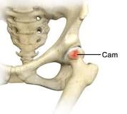 Image result for what is treatment for hip lesion