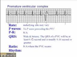 Ecg Premature Ventricular Complexes Pvc Paramedic School Ekg Interpretation Nursing Study