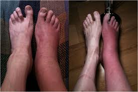 Living With Complex Regional Pain Syndrome And Bone Marrow Oedema Rare Disease Uk