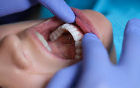 Image result for dental cancer