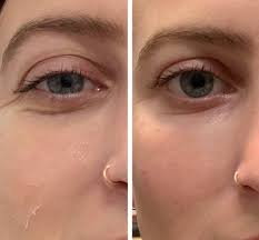 However, certain factors can make you more likely to get a stye. What To Know Before Getting Undereye Fillers Popsugar Beauty