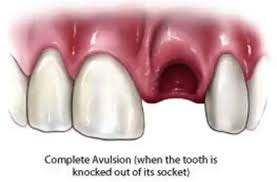 Image result for Tooth Avulsion