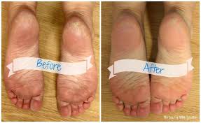 You can get rid of the dead skin easily at home by following a routine with some basic ingredients. Vicks Vaporub On Your Feet For Cracked Heels Mentholatum