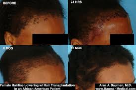 Additionally, ethnic styles are also available such as batik fabrics and traditional african style wraps. African American Female Hair Transplant Results Bauman Medical
