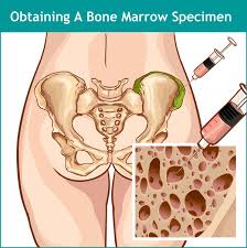 Image result for Bone Marrow Exam