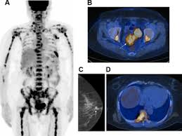 Before a pet/ct scan, an iv that injects a small amount of a radioactive substance will be placed into one of your veins. Role Of 18f Fdg Pet Ct In Patients Without Known Primary Malignancy With Skeletal Lesions Suspicious For Cancer Metastasis