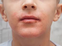 Image result for vyrážka u dětí