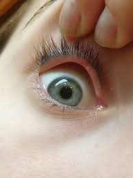 Weniger gut sichtbar ist ein sogenanntes internes hordeolum: Gerstenkorn Hagelkorn Was Ist Das Mit Bild Augen Augenarzt Augenschmerzen