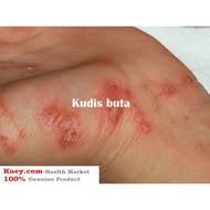 Kudis buta adalah penyakit yang melibatkan satu parasit bernama sarcoptes scabiei dimana pesakit akan mengalami kegatalan yang teruk pada. Kudis Buta Ubat Price Promotion Feb 2021 Biggo Malaysia