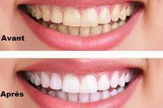 RÃ©sultat de recherche d'images pour "3 maniÃ¨res simples pour blanchir vos dents naturellement."