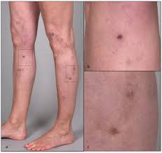 Image result for Pigment stains on the shin