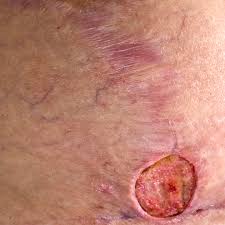 Do not make multiple passes over the same area to prevent irritation and development of ingrown pubic hairs. Abscess Symptoms Causes Photos And Treatment