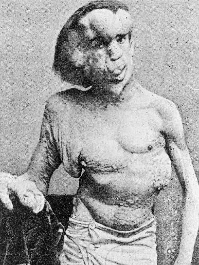 No fim do século XIX, milhares de pessoas faziam fila em Londres para  assistir a um espetáculo que hoje seria considerado desumano. No centro da  atração estava Joseph Merrick, um jovem inglês