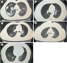 Delivery Of Infection From Asymptomatic Carriers Of Covid 19 In A Familial Cluster International Journal Of Infectious Diseases