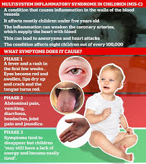 Children Who Catch The Common Could Be Immune To Mis C Daily Mail Online