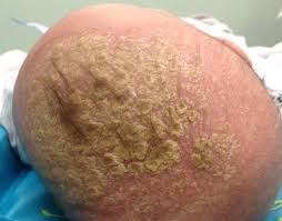 Image result for Cradle Cap