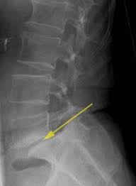 Spinalkanalstenose Verengung Des Ruckenmarks Der Wirbelsaule Gelenk Klinik De