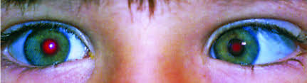 For example, a bladder cancer or a cancerous lymph node in the abdomen may compress the tube (ureter) connecting a kidney with the bladder when cancer grows in an area with a lot of space, such as in the wall of the large intestine or the lung cavity, it may not cause any symptoms until it becomes. What Is Retinoblastoma Childhood Eye Cancer Trust