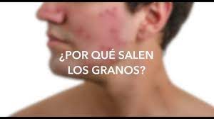 Acne Razones Por Las Cuales Te Salen Granos Youtube
