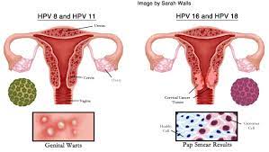 Hpv (human papillomavirus) is a sexually transmitted virus. Human Papillomavirus Hpv Strains 16 And 18 The Embryo Project Encyclopedia