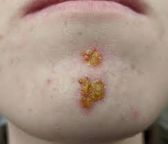 Image result for Skin Infection