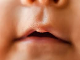 Browse 4,997 toddler mouth stock photos and images available, or search for toddler mouth open to find more great stock photos and pictures. Blister On Baby Lip Causes Treatments And More