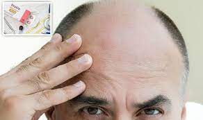 Widely prescribed in the treatment of high cholesterol, statins work by blocking the we don't know exactly why statins might cause hair loss. Statins Side Effects The Cholesterol Lowering Drug May Cause Hair Loss Express Co Uk
