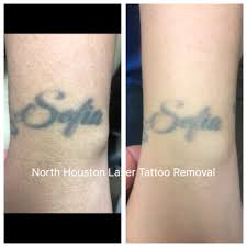 This is mostly because great quality artists work with high quality as you can see there many reasons why a tattoo can fade, and a lot of them. How Long Will It Take Before I See My Tattoo Fade North Houston Laser Tattoo Removal
