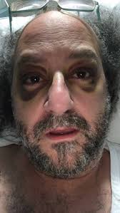 Man hit by car at pedestrian crossing calls for intersection of Mitchell,  Mollison streets to be upgraded