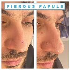 Irritation on right side of cheek near nose where i saw a scaly spot. Fibrous Papule Fibrous Papule Of The Nose Fibrous Papule Treatment