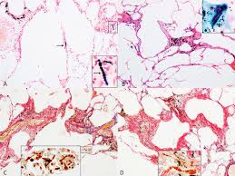 Prolonged exposure to these fibers can cause lung tissue scarring and shortness of breath. Asbestos Exposure Results In Asbestosis And Usual Interstitial Pneumonia Similar To Other Causes Of Pneumoconiosis Intechopen