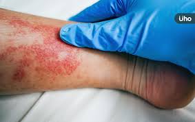 全身蝴蝶斑、關節腫痛⋯醫警告「此病」易復發：逾5成嚴重器官損傷|Uho優活健康網