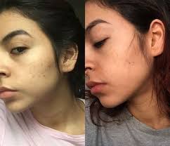 The theory is that over time, the mole will eventually peel off. How To Remove Beauty Mark Bmo Show