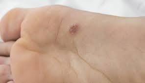 Image result for Acral lentiginous melanoma nail