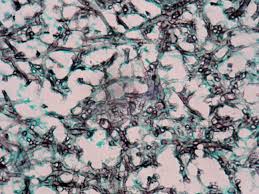 Pulmonary aspergillosis is a collective term used to refer to a number of conditions caused by infection with a fungus of the aspergillus species (usually aspergillus fumigatus). Pathology Outlines Aspergillus