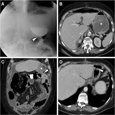 A 77-year-old female with distal gastric carcinoma underwent partial...