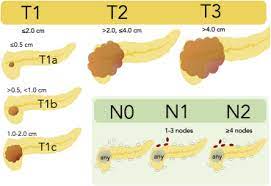 We did not find results for: Refined Tnm Staging For Pancreatic Adenocarcinoma Real Progress Or Much Ado About Nothing Sciencedirect