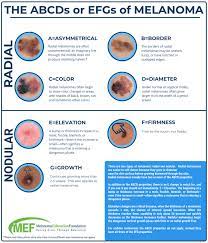 Whatever the cause, if you're looking to regain a more eve. The Abcds Or Efgs Of Melanoma Melanoma Education Foundation